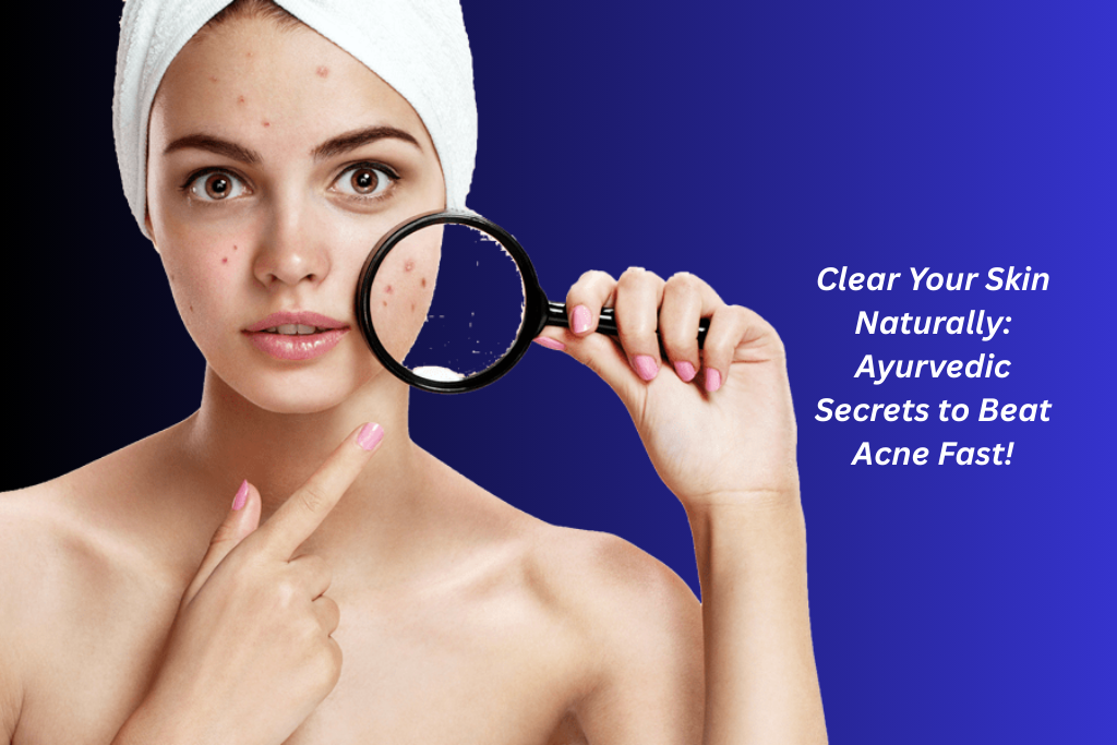 Ayurvedic Treatment for Acne