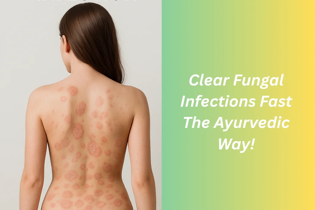 Ayurvedic Treatment for Fungal Infection of Skin